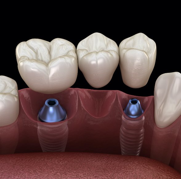 Animated smile during dental implant supported bridge placement