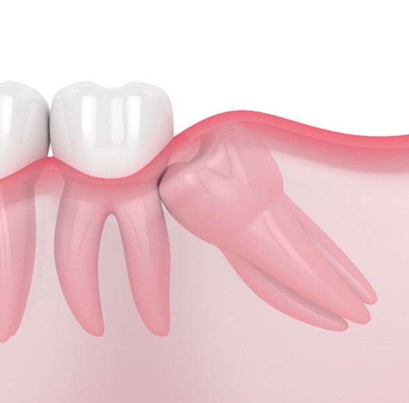 Illustration of an impacted wisdom tooth next to other teeth