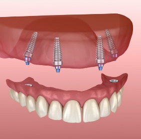 Animated smile with dental implant retained denture