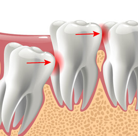 image of impacted tooth