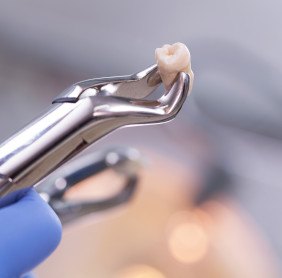 Extracted tooth held in dental forceps